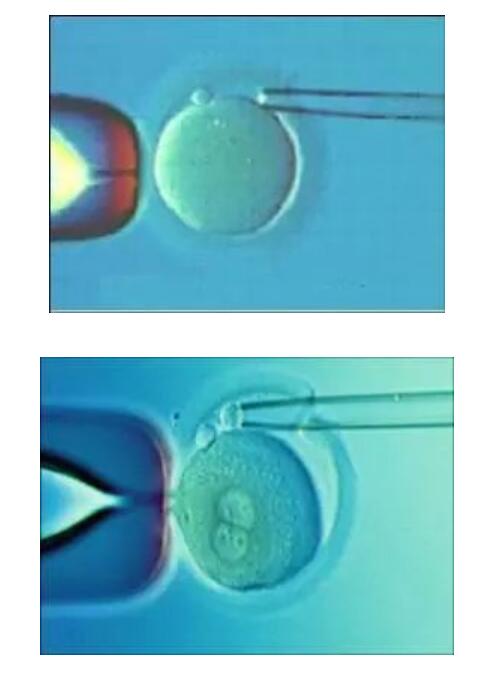 试管婴儿取卵手术并发症预防措施探讨